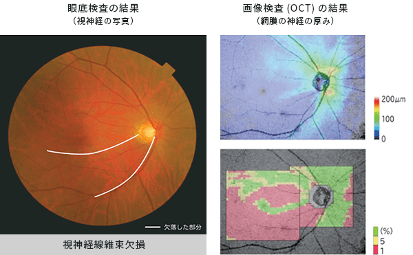 眼底検査の結果と画像検査（OCT）の結果
