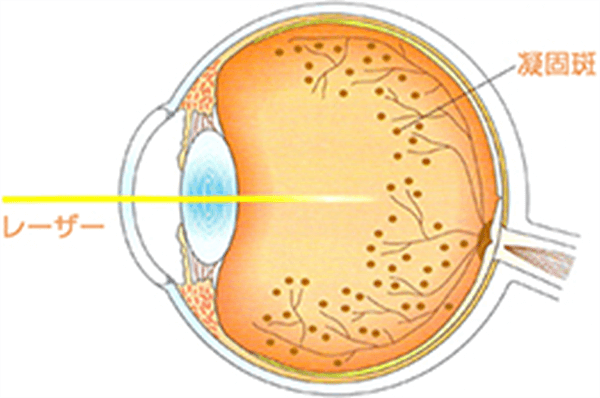 網膜光凝固術とはレーザー光線を網膜の傷んだ部位に照射して治療を行う方法